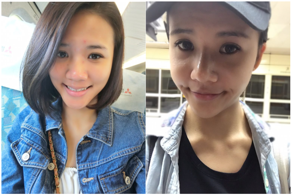 台中醫美/峻美診所-勇敢追夢with卡麥拉隆鼻,重新蛻變自我,找回自信新生感! 民生資訊分享 醫美
