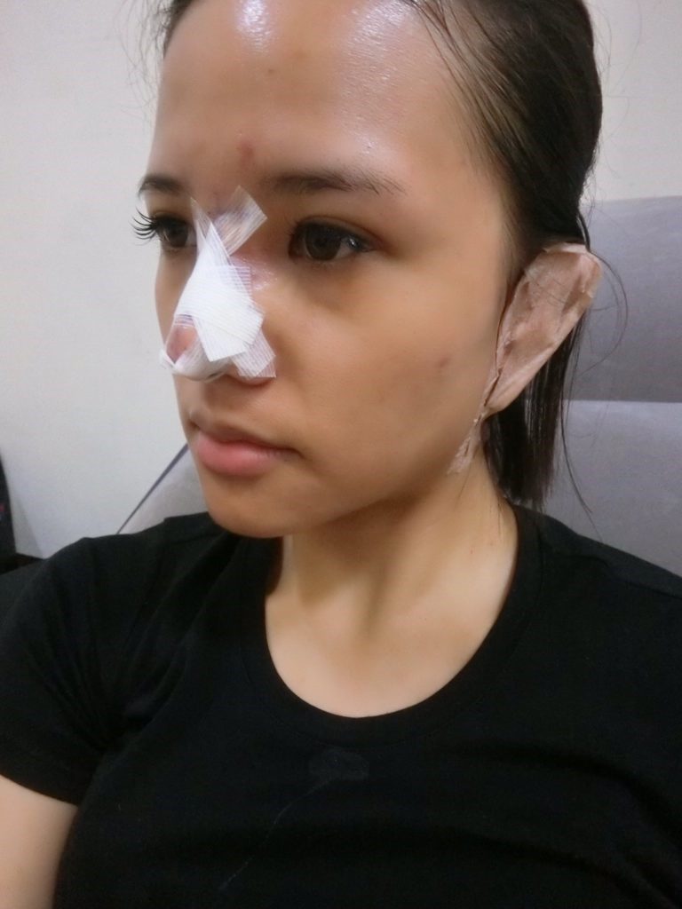 台中醫美/峻美診所-勇敢追夢with卡麥拉隆鼻,重新蛻變自我,找回自信新生感! 民生資訊分享 醫美