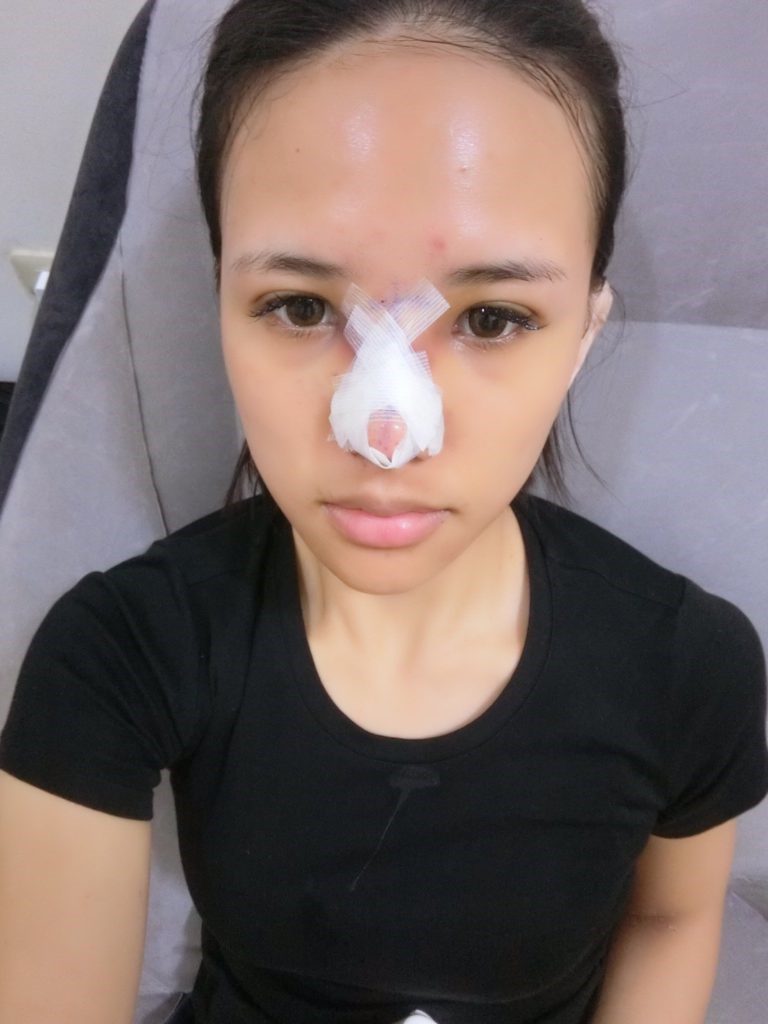 台中醫美/峻美診所-勇敢追夢with卡麥拉隆鼻，重新蛻變自我，找回自信新生感！ 民生資訊分享 醫美 