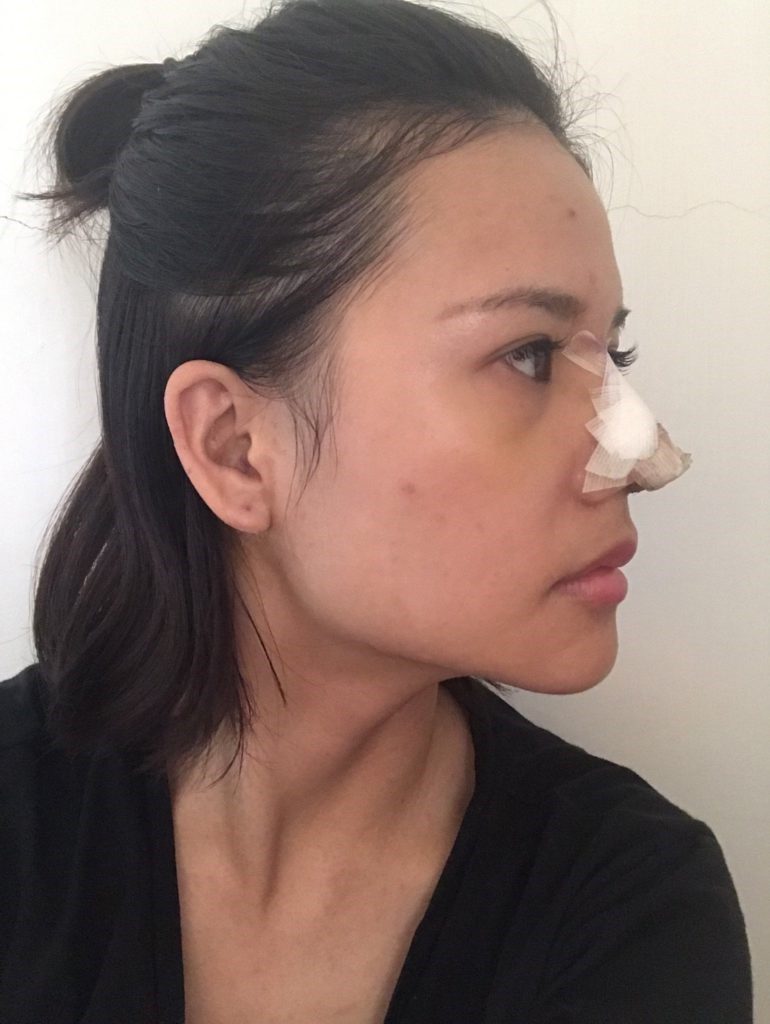 台中醫美/峻美診所-勇敢追夢with卡麥拉隆鼻,重新蛻變自我,找回自信新生感! 民生資訊分享 醫美