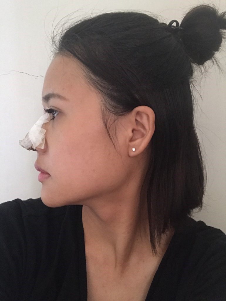 台中醫美/峻美診所-勇敢追夢with卡麥拉隆鼻,重新蛻變自我,找回自信新生感! 民生資訊分享 醫美