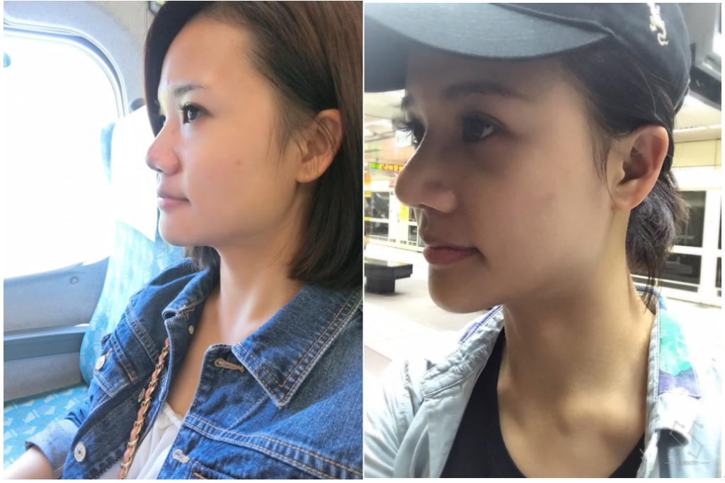 台中醫美/峻美診所-勇敢追夢with卡麥拉隆鼻,重新蛻變自我,找回自信新生感! 民生資訊分享 醫美
