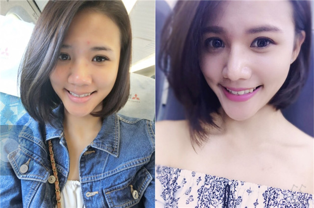 台中醫美/峻美診所-勇敢追夢with卡麥拉隆鼻,重新蛻變自我,找回自信新生感! 民生資訊分享 醫美